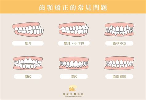 上下排牙齒平行|咬合不正怎麼辦？會影響臉型？原因、矯正方式一次看。